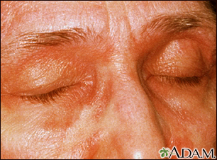 Dermatomyositis - heliotrope eyelids - Illustration Thumbnail
              