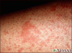 Eczema, atopic - close-up - Illustration Thumbnail