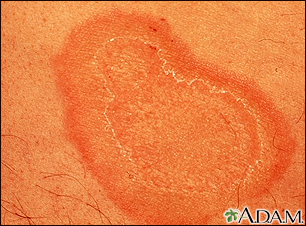 Erythema annulare centrifugum - close-up - Illustration Thumbnail
              