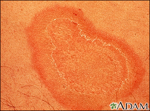 Erythema annulare centrifugum - close-up - Illustration Thumbnail
                      