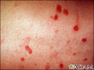 a) Day 1, patient presents with flat erythematous rash with scattered