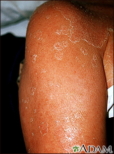 Clinical picture of Case 1 showing an erythematous, mildly crusted