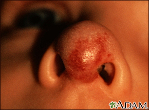 Hemangioma on the face (nose) - Illustration Thumbnail
              