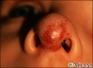 superficial hemangioma