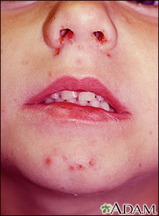 impetigo in children face