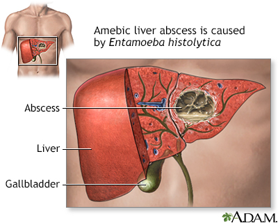 Amebic liver abscess