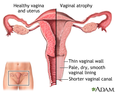 dry vaginal area