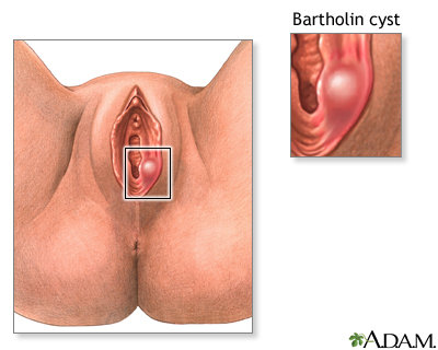 Bartholin cyst or abscess - Illustration Thumbnail
              