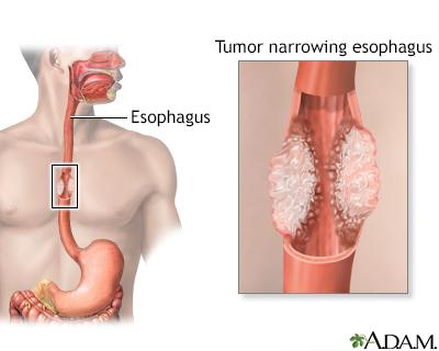 Esophageal cancer - Illustration Thumbnail
              