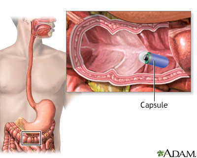 Capsule endoscopy - Illustration Thumbnail
                      