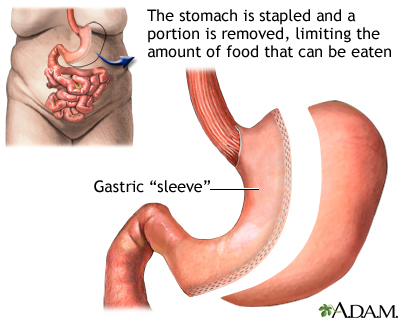 Procedure - Sleeve gastrectomy