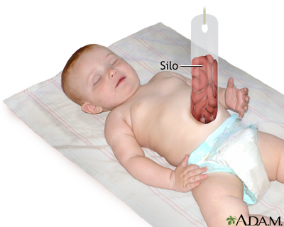 Gastroschisis Prognosis