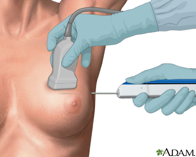 Core needle biopsy of the breast - Illustration Thumbnail
                      