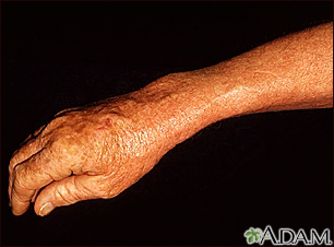 Lentigo - solar with erythema on the arm