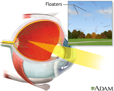 Eye floaters - Illustration Thumbnail
              