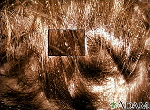 Lice, head - nits in the hair with close-up