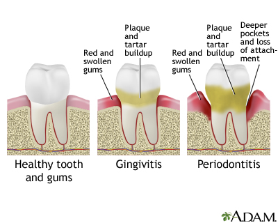 Gum Bacterial Infection