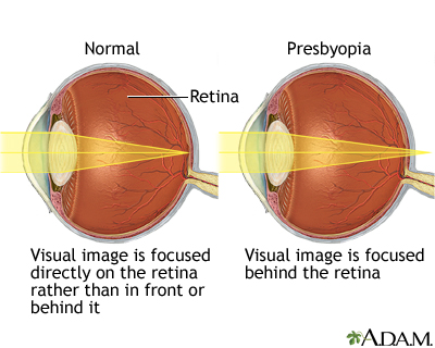 presbyopia jelentése magyarul