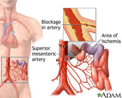 Mesenteric artery ischemia and infarction - Illustration Thumbnail
              