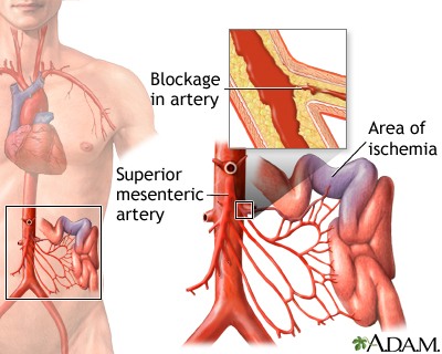 Mesenteric artery ischemia and infarction - Illustration Thumbnail
                      