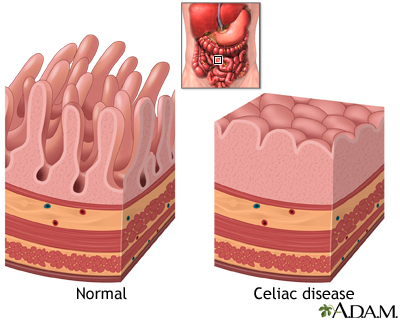 Celiac disease - Illustration Thumbnail
                      