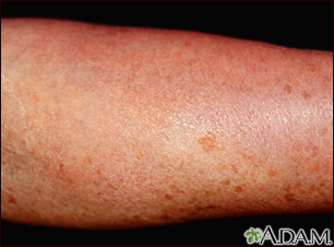 Urticaria pigmentosa Information