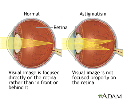 Astigmatism Eye Shape