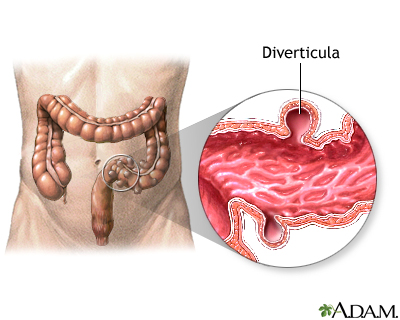 Diverticula - Illustration Thumbnail
                      