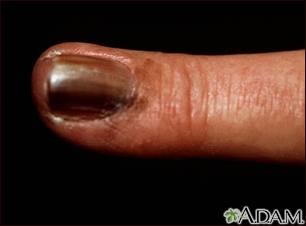 Skin cancer, melanoma on the fingernail - Illustration Thumbnail
              