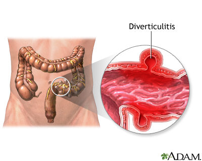 Diverticulitis What To Ask Your Doctor Information Mount Sinai   24390 