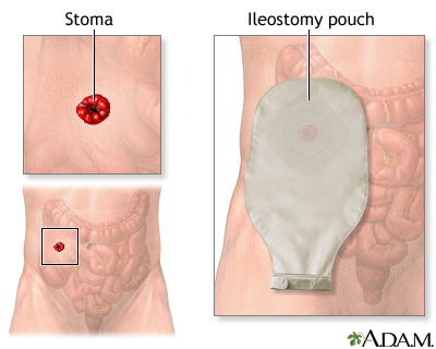 Ileostomy - changing your pouch Information