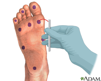 Peripheral neuropathy Information Mount Sinai New York