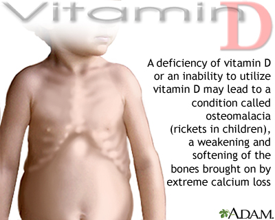 Vitamin D deficit