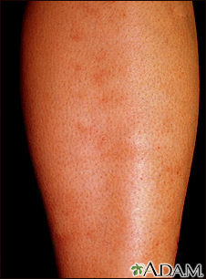 Polyarteritis - microscopic on the shin