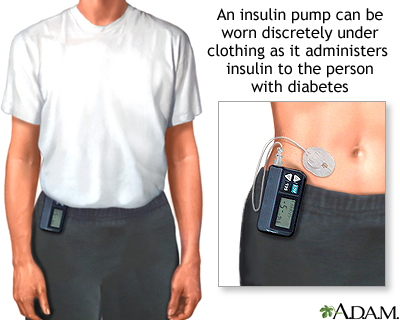 Insulin pump - Illustration Thumbnail              