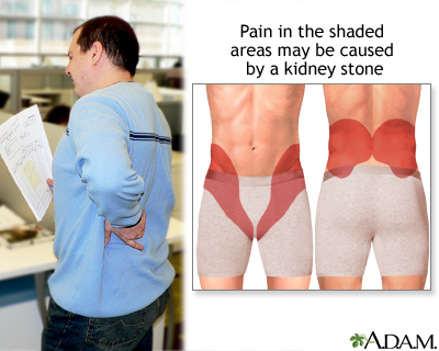 Kidney Pain: Causes, Treatment, and When to See a Healthcare Provider