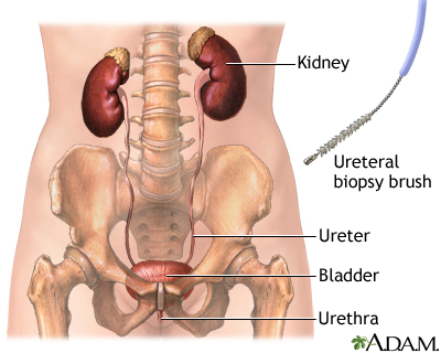 Ureteral biopsy