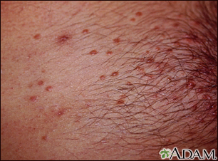 hiv rash chest