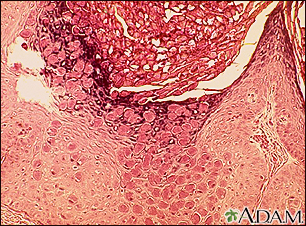 Molluscum - microscopic appearance - Illustration Thumbnail
                      