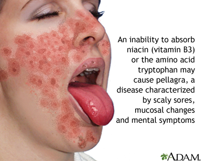 niacin deficiency