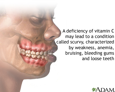 Vitamin C deficit - Illustration Thumbnail              