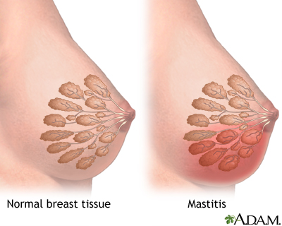 Breast infection Information