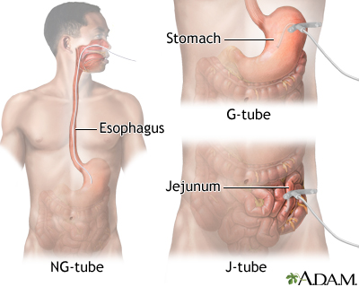 Feeding tube deals in nose