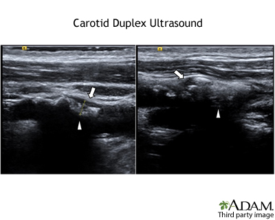 Carotid Duplex Ultrasound