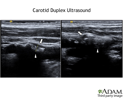 Carotid Duplex Ultrasound - Illustration Thumbnail
                      