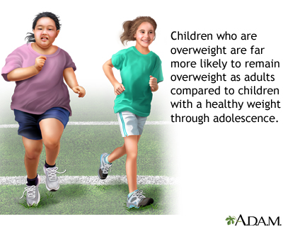 Childhood obesity - Illustration Thumbnail
              