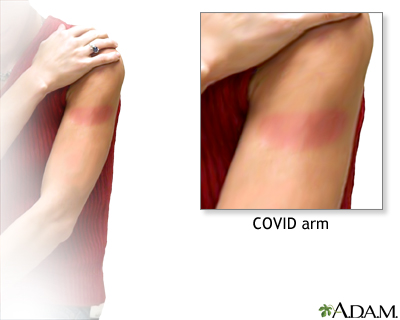 Arm Rash After COVID-19 Vaccination