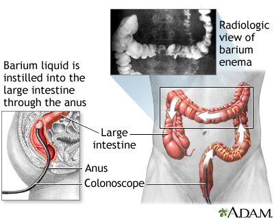 Barium enema - Illustration Thumbnail
              