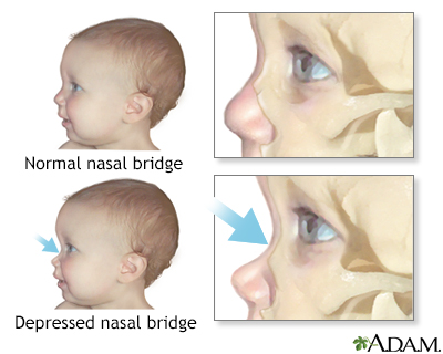 Depressed nasal bridge - Illustration Thumbnail              