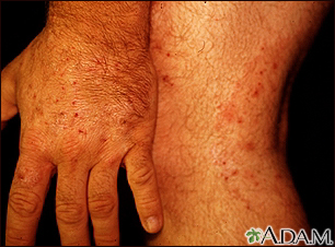 Thedoctorwrites - Tinea corporis is a superficial fungal infection